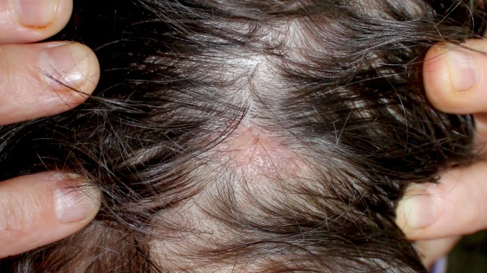 Scalp health and hair loss